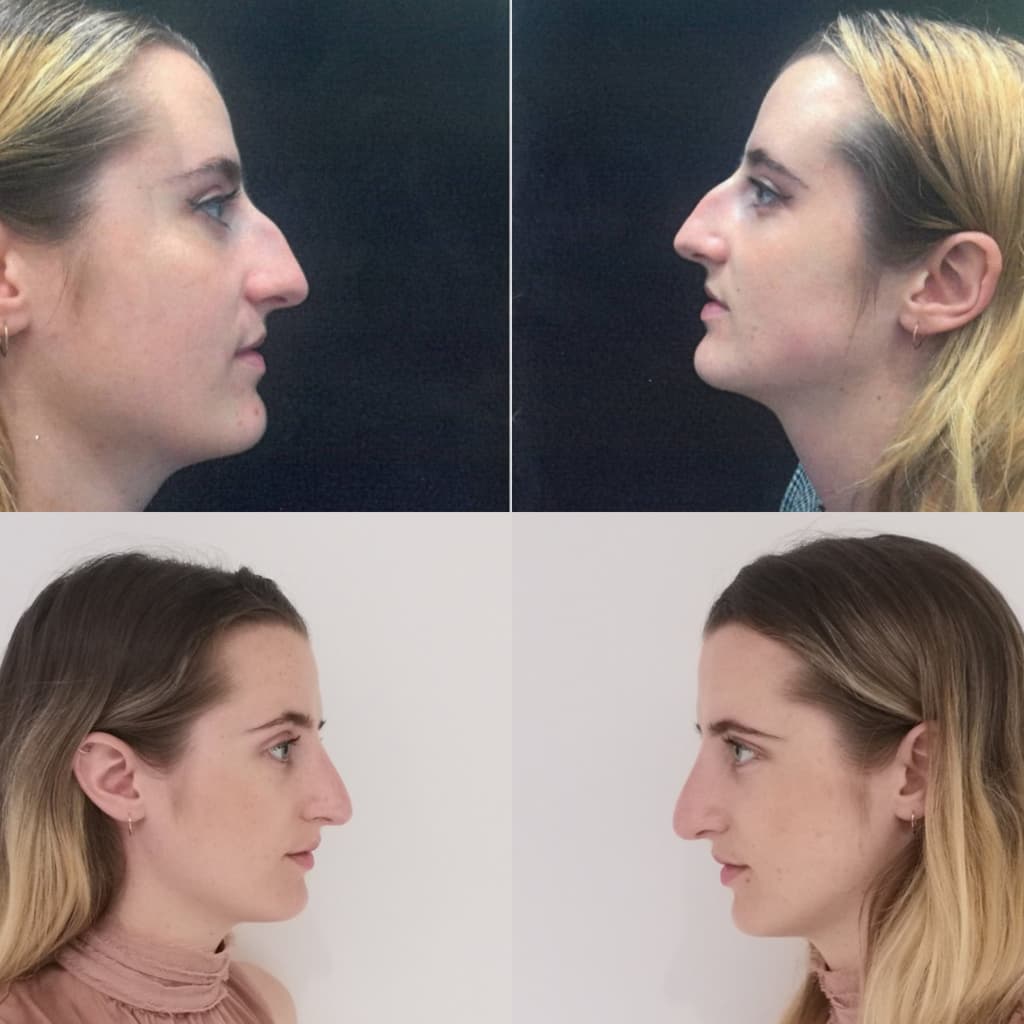 My Rhinoplasty Results! image 1