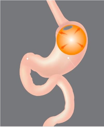 Gastric Balloon