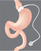 Gastric Band