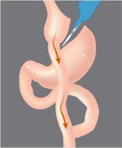 Gastric Bypass