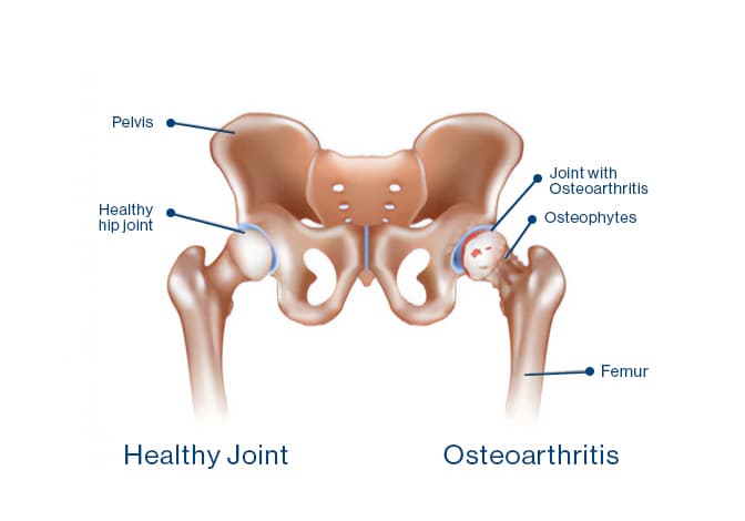 23-10-09_HipOsteoarthritis