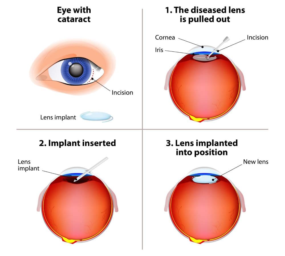 Cataract surgery diagram