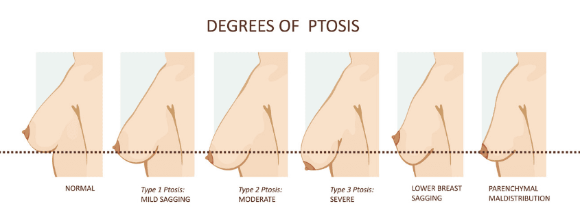 Ptosis Diagram