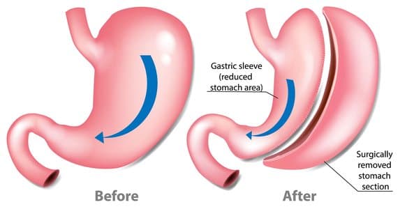 gastric sleeve before and after