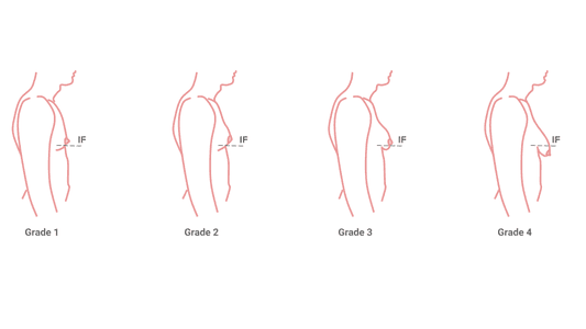 grades of gynaecomastia