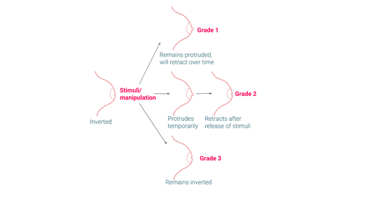 grades of nipple inversion