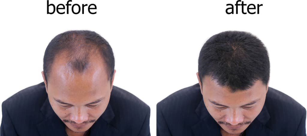 hair-transplant.jpg