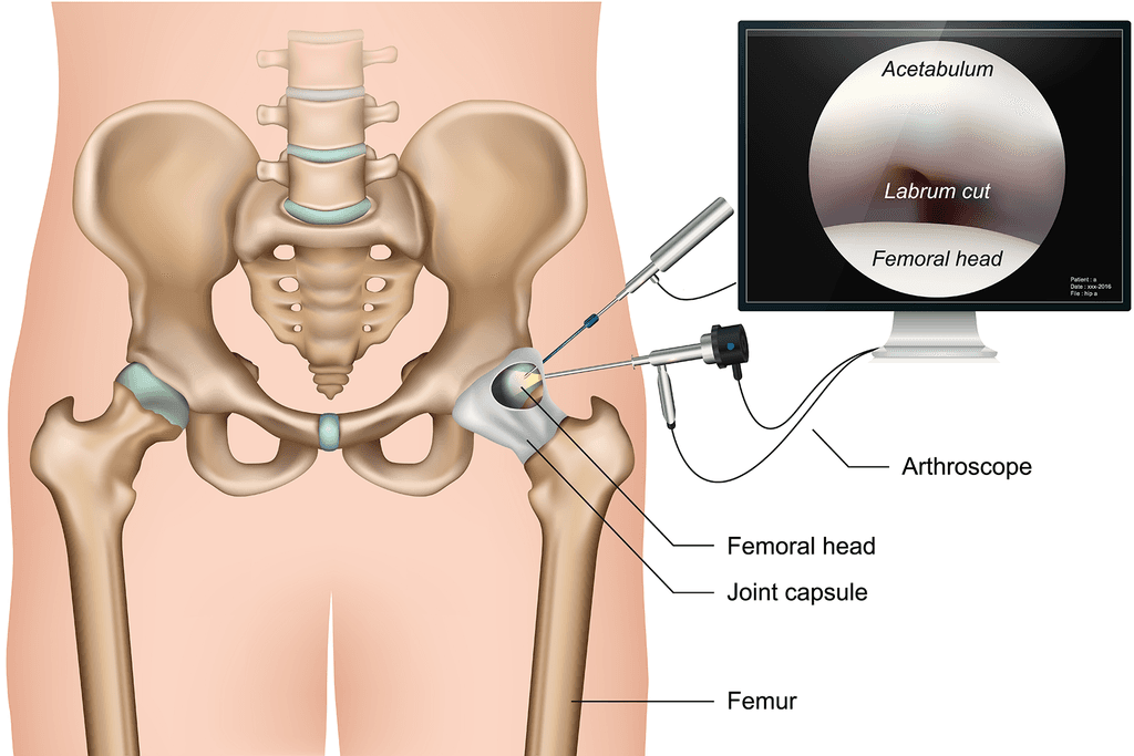 hip arthroscopy incisions.png