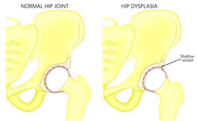 hip dysplasia diagram.jpg