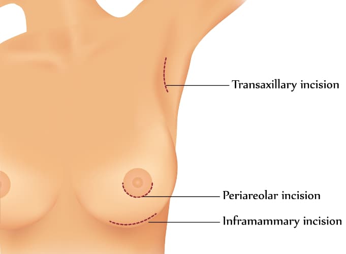 incisions_breast_enlargement_augmentation.jpg