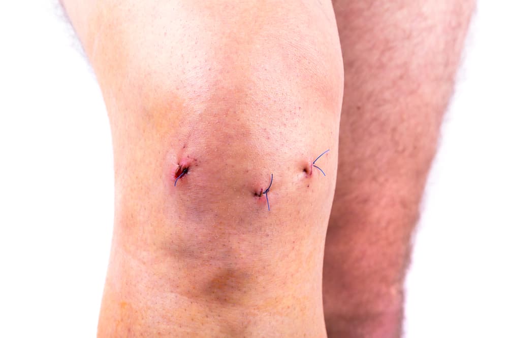 meniscus repair incisions.jpg