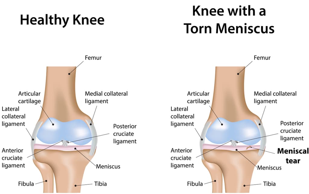 meniscus tear.jpg