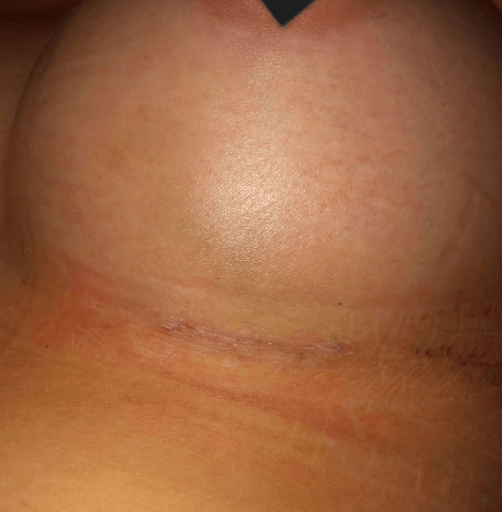 2 Weeks Post-Op image 1