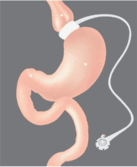 Gastric Band