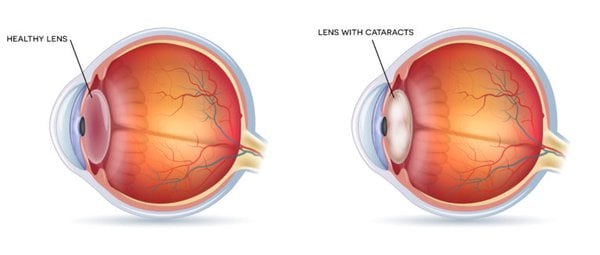 Cataract diagram