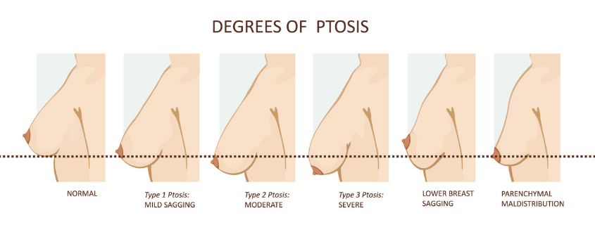 Ptosis Diagram