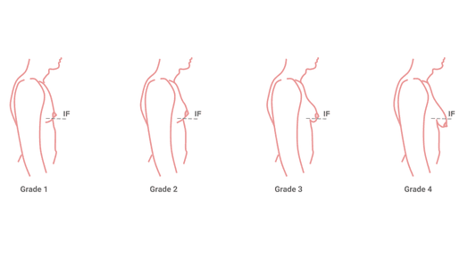 grades of gynaecomastia