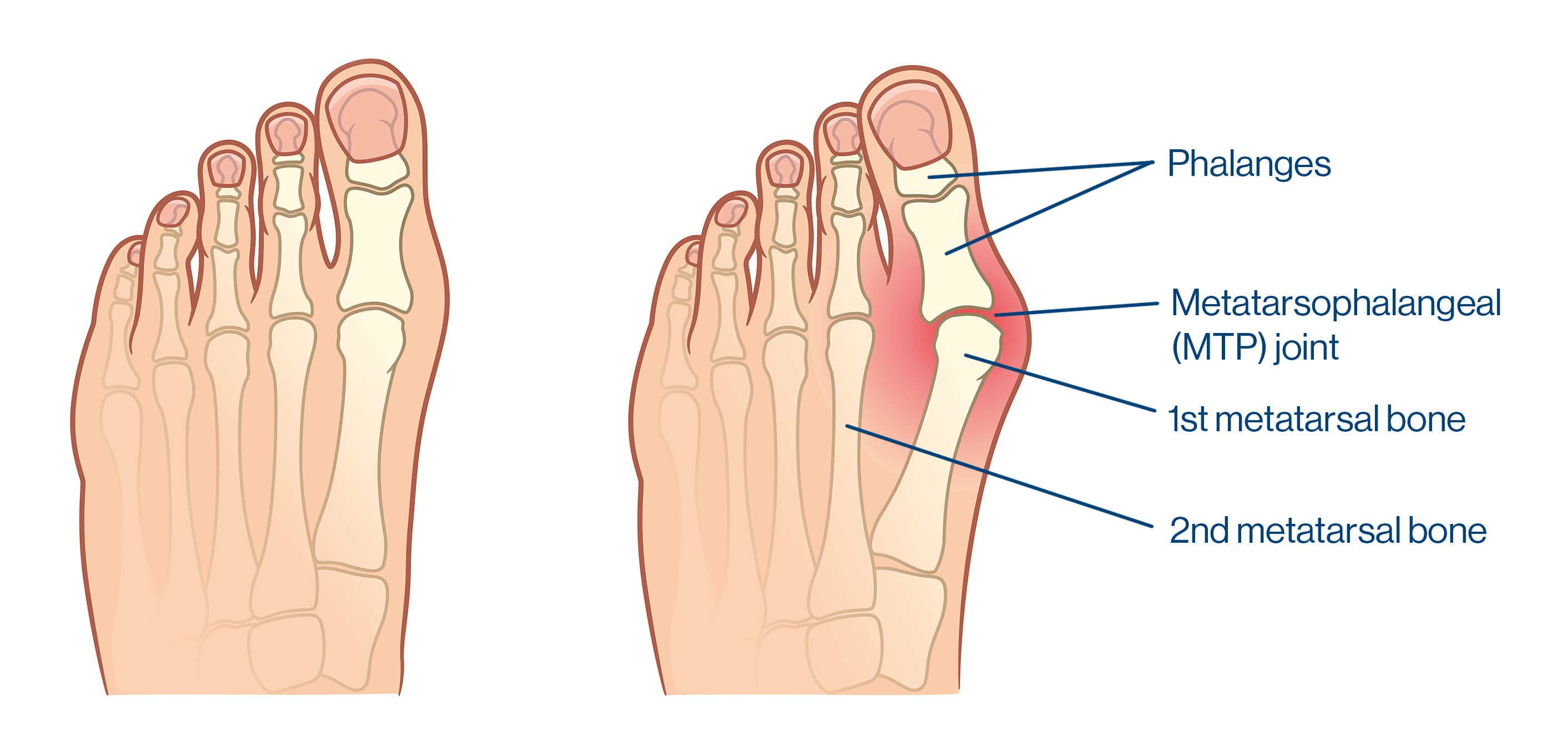 Bunion medical