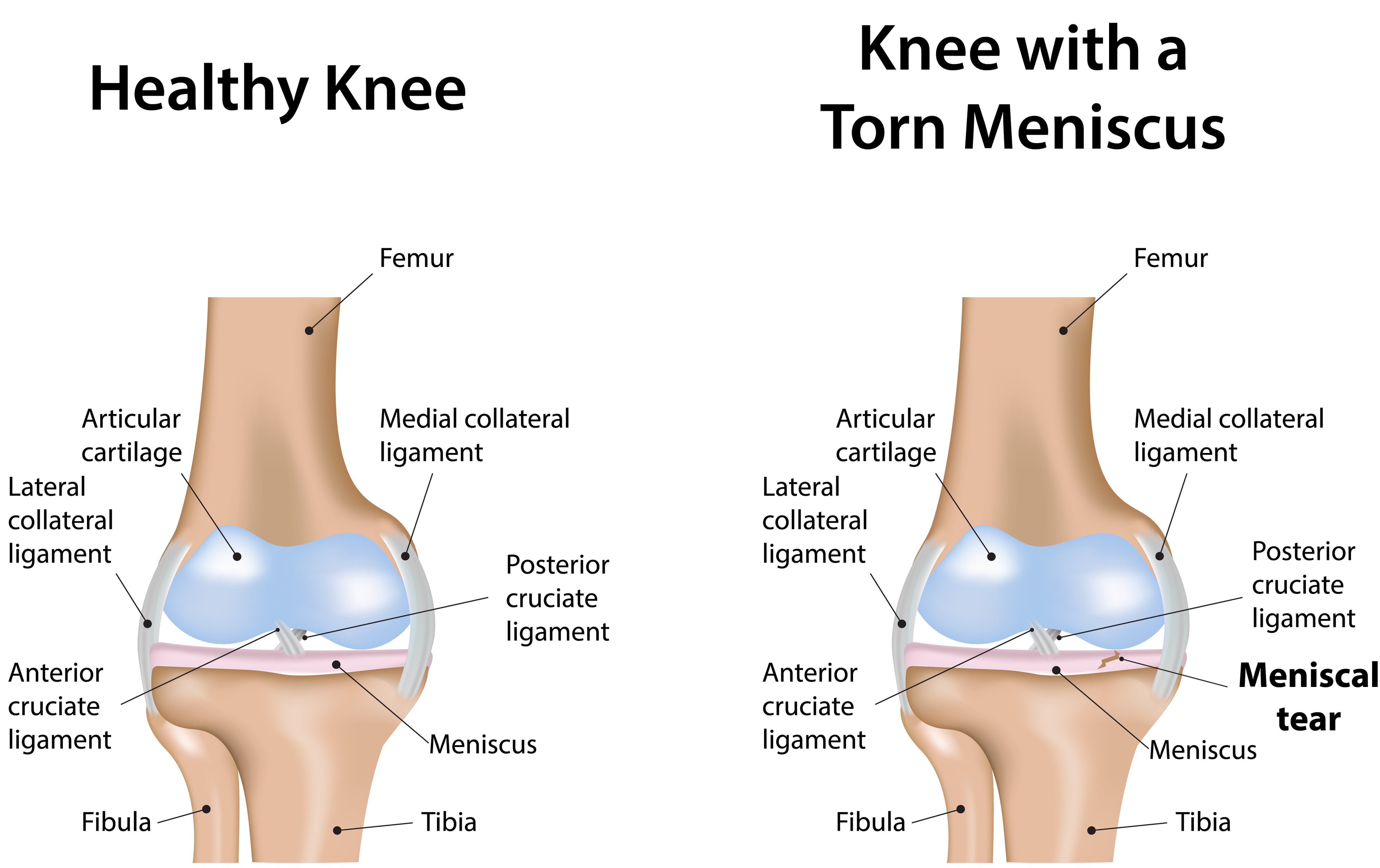 meniscus tear.jpg