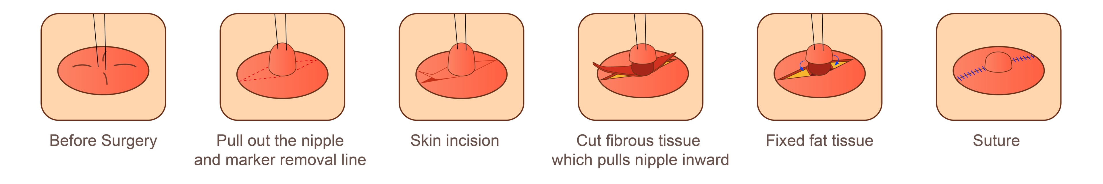 nipple correction surgery