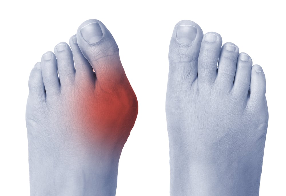 Bunion non-medical