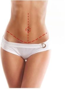 fleur de lis abdominoplasty incisions